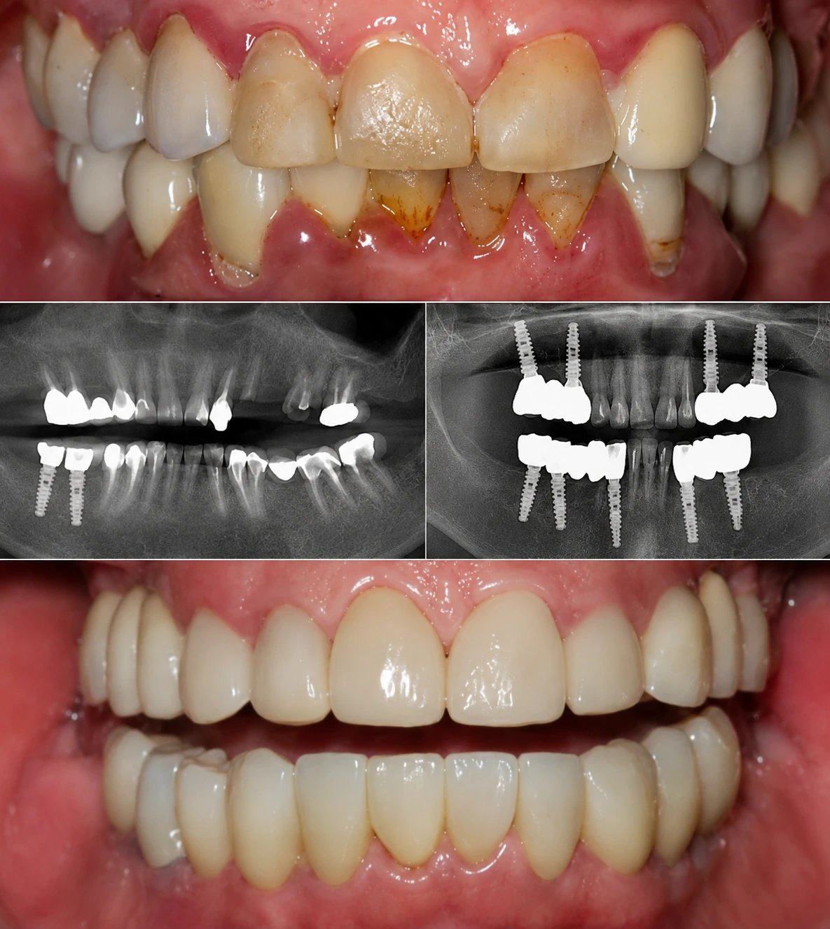 Caso real de rehabilitación sobre implantes en Rehab Dent