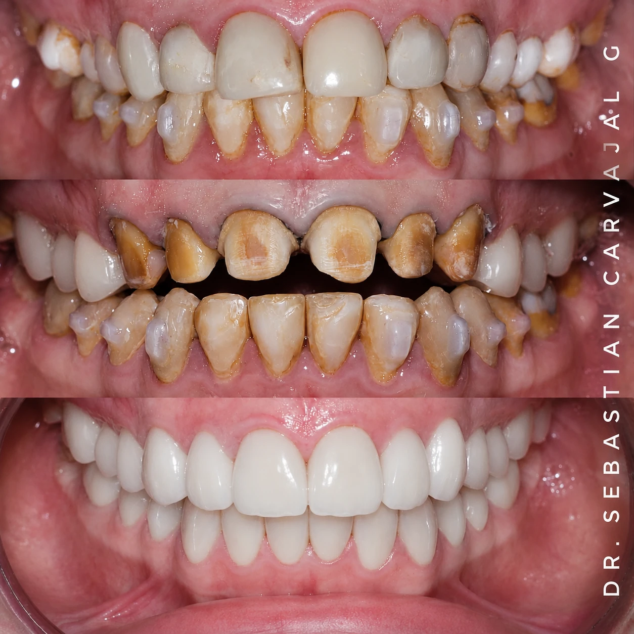 Caso real de rehabilitación oral en Rehab Dent