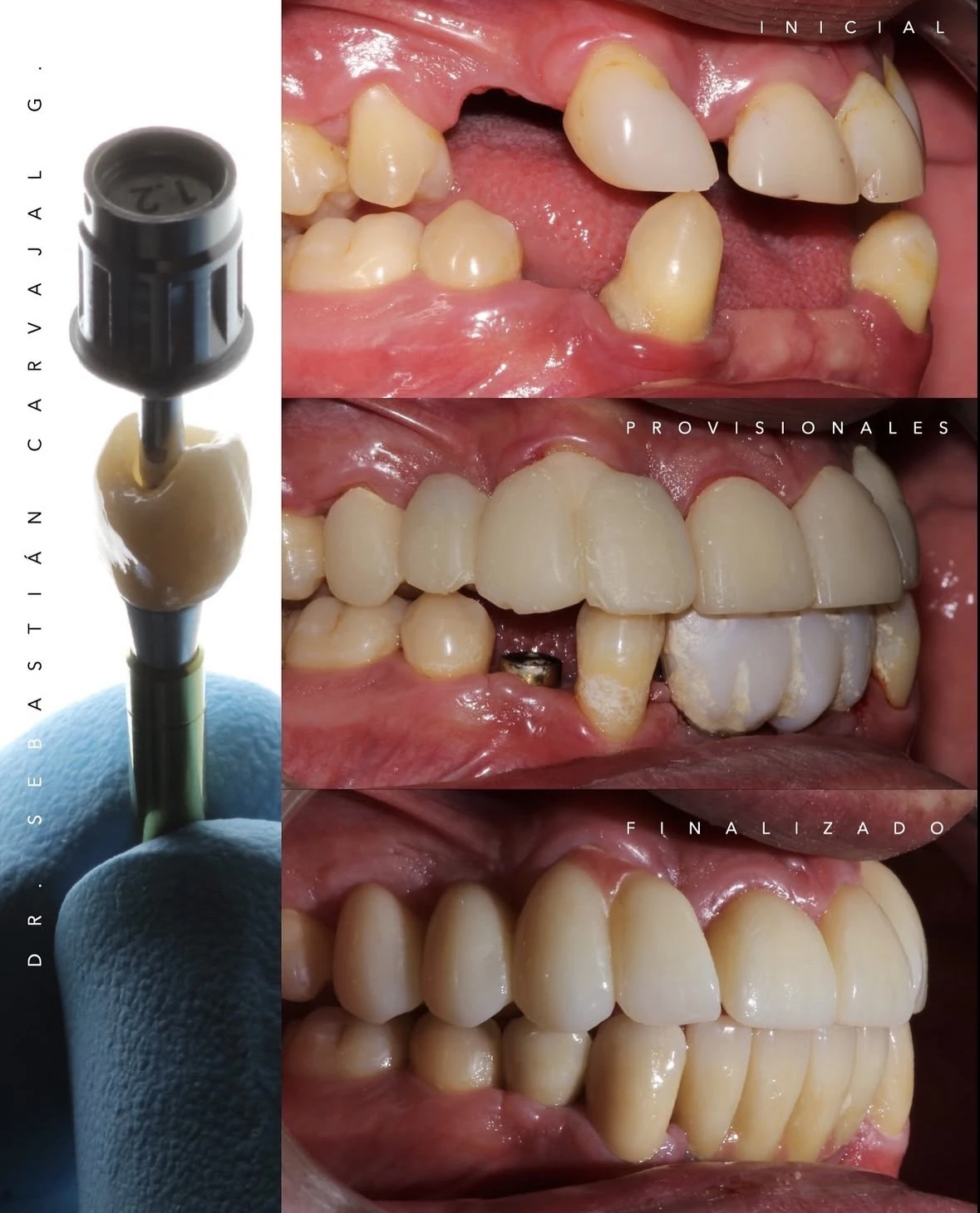 Caso real de corona sobre implante dental en Rehab Dent