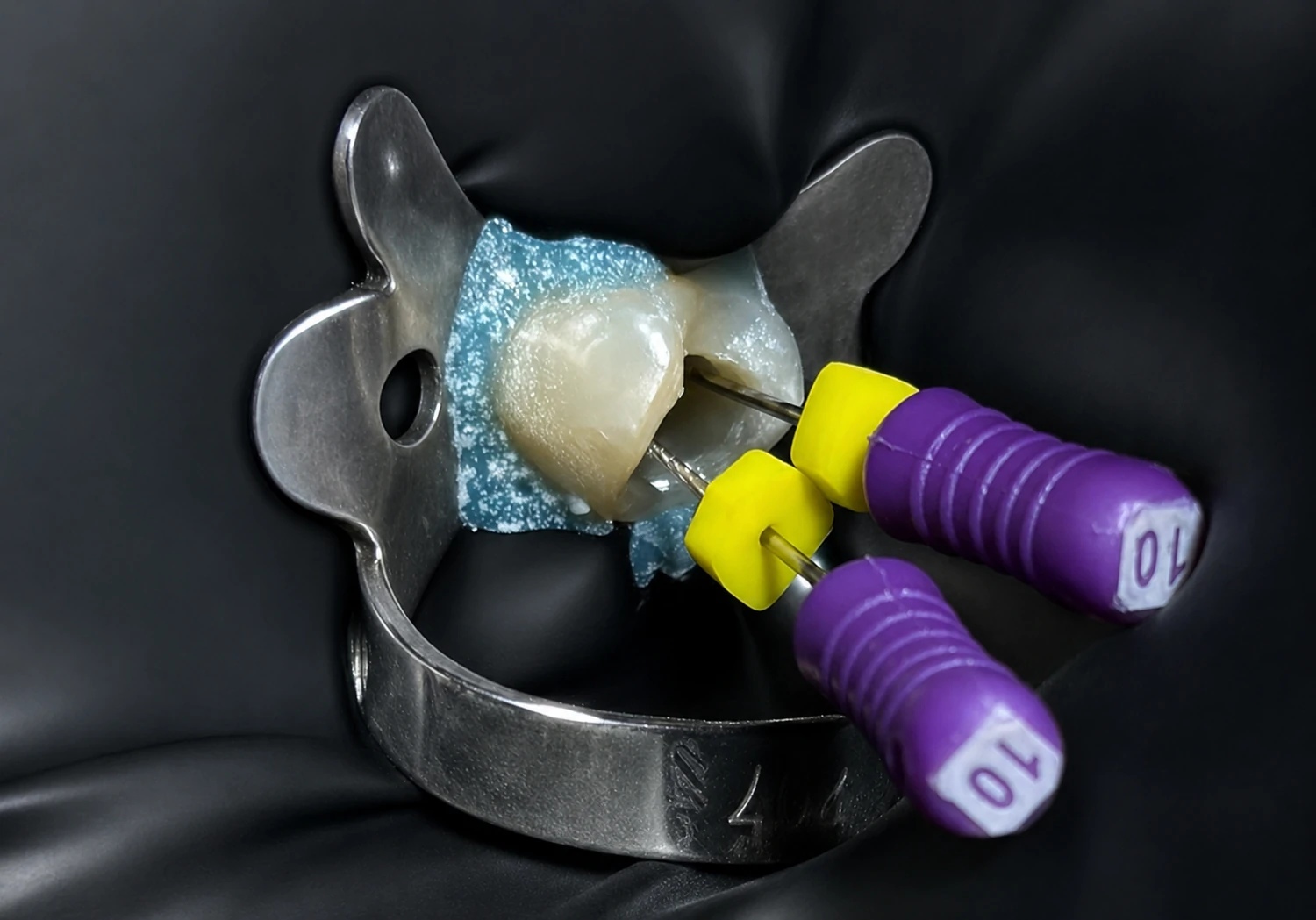 Caso real de endodoncia en Rehab Dent