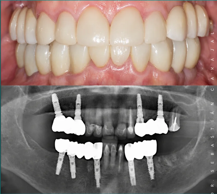 Instalación y terminación de rehabilitación dental